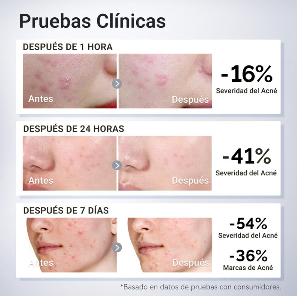 Maleva™ Tratamiento Secante para Acné