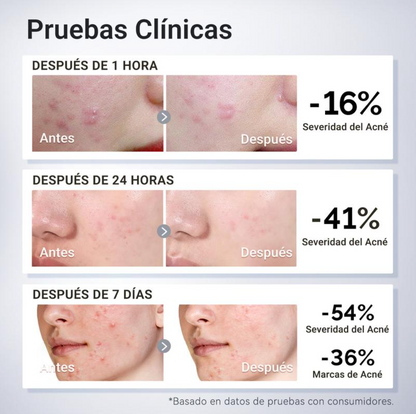 Maleva™ Tratamiento Secante para Acné
